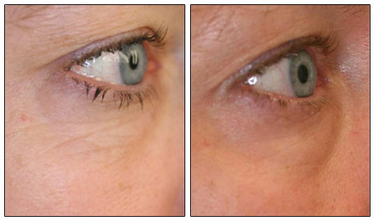 Hyaluronic Acid Results